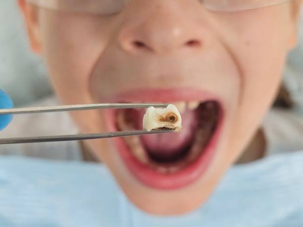 Best Emergency Treatment for Toothache in Grove Hill, AL